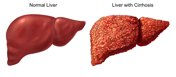 Treatment of Cirrhosis Of Liver in HSR Layout