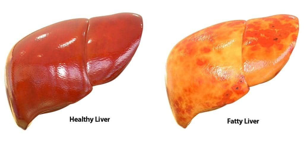 Fatty Liver Treatment in HSR Layout