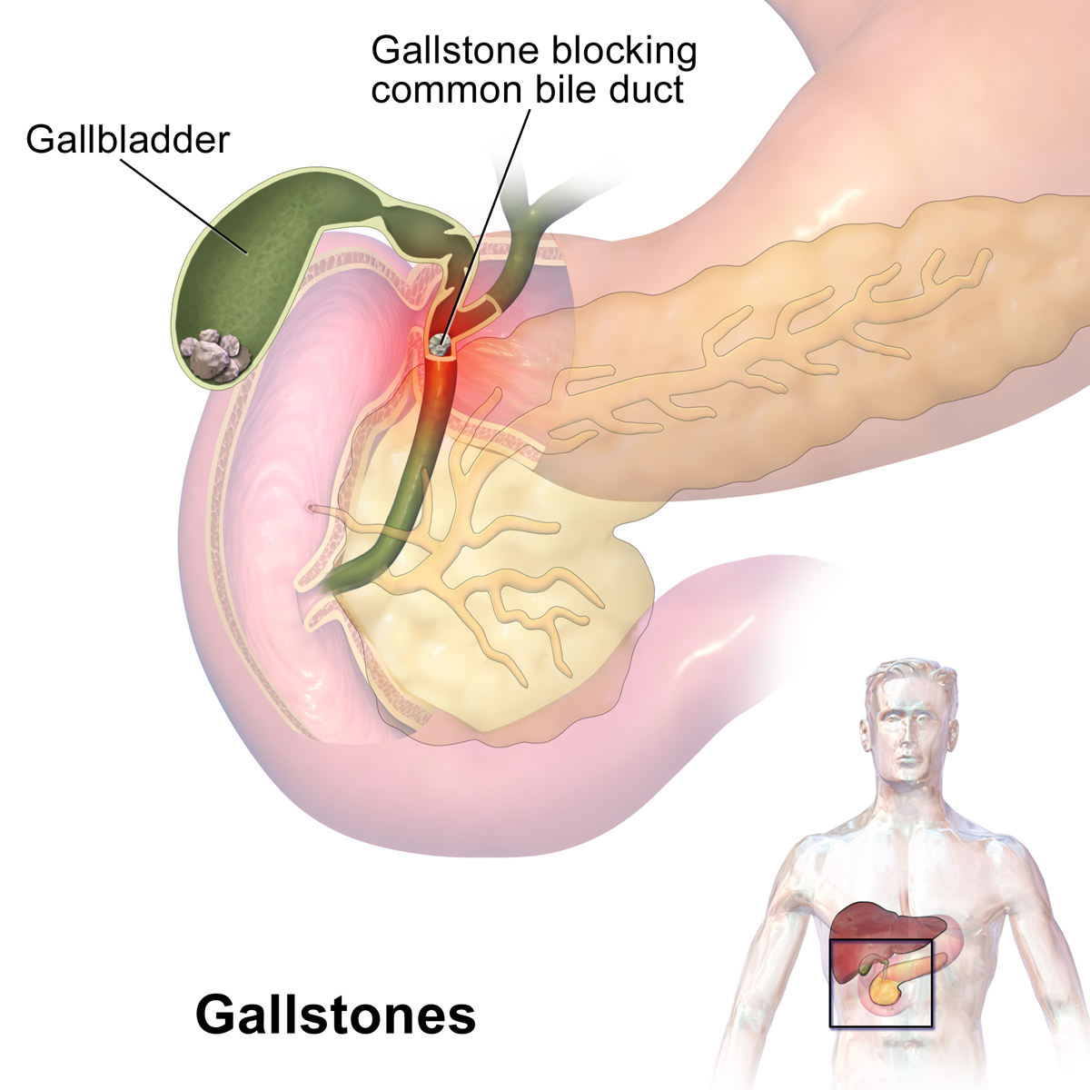Gallstones Removal in HSR Layout
