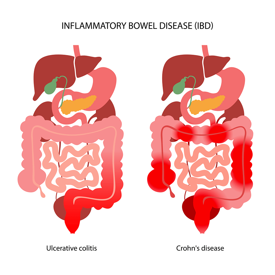 IBD Treatment in HSR Layout